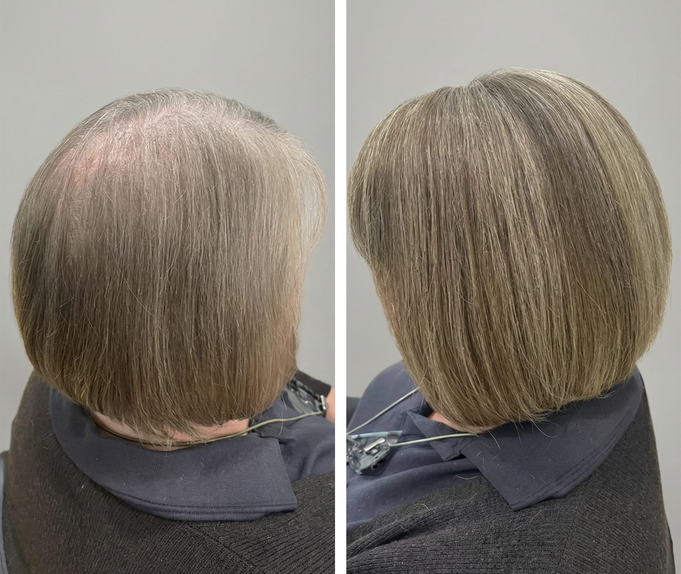 Remy human hair topper blending perfectly with natural texture.