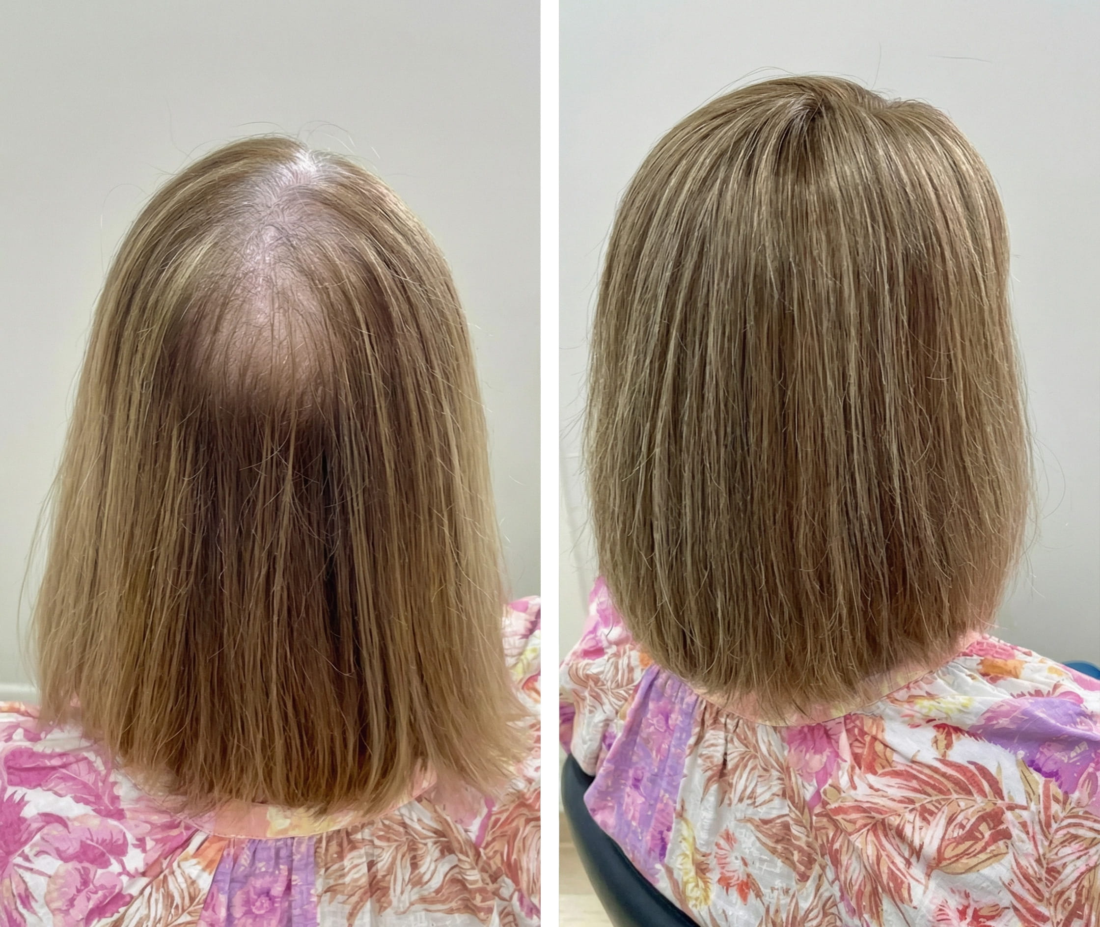 Premium topper providing full coverage and natural appearance.